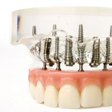 implant supported dentures